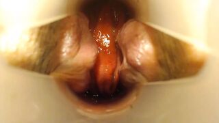 Anal speculum and show inside my asshole - 1 image